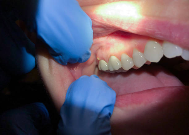 Best Dental Abscess Treatment in Pine Ridge At Crestwood, NJ